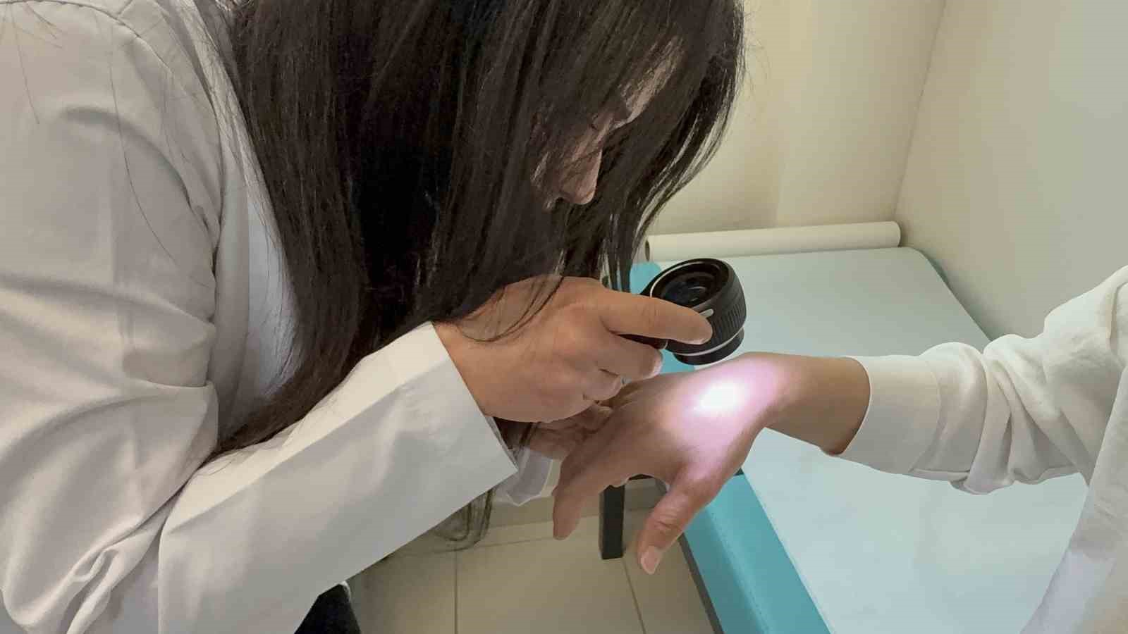 Güneşe dikkat: Alerji vakalarında artış başladı