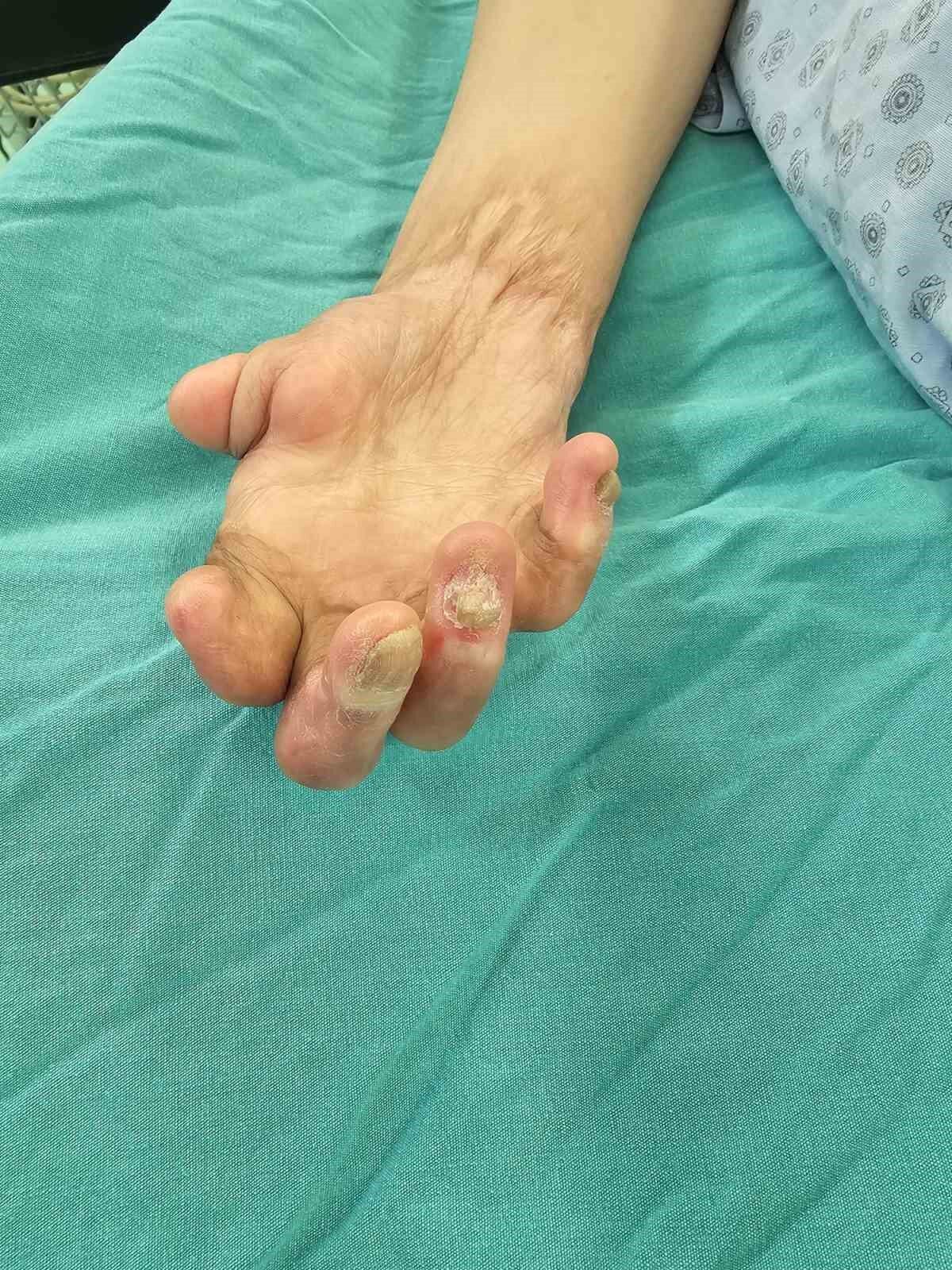 Çin zulmünden kaçan Uygur Türk’ü Ayşe, Eskişehir’de şifa buldu