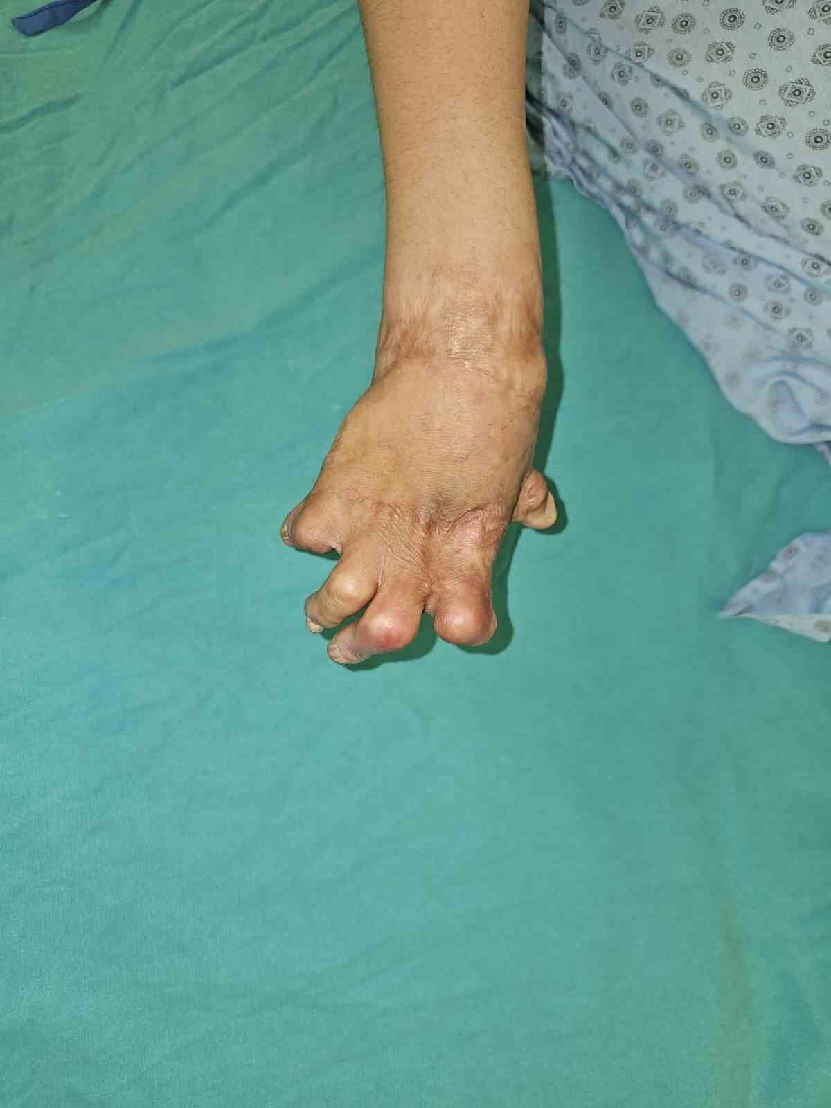 Çin zulmünden kaçan Uygur Türk’ü Ayşe, Eskişehir’de şifa buldu