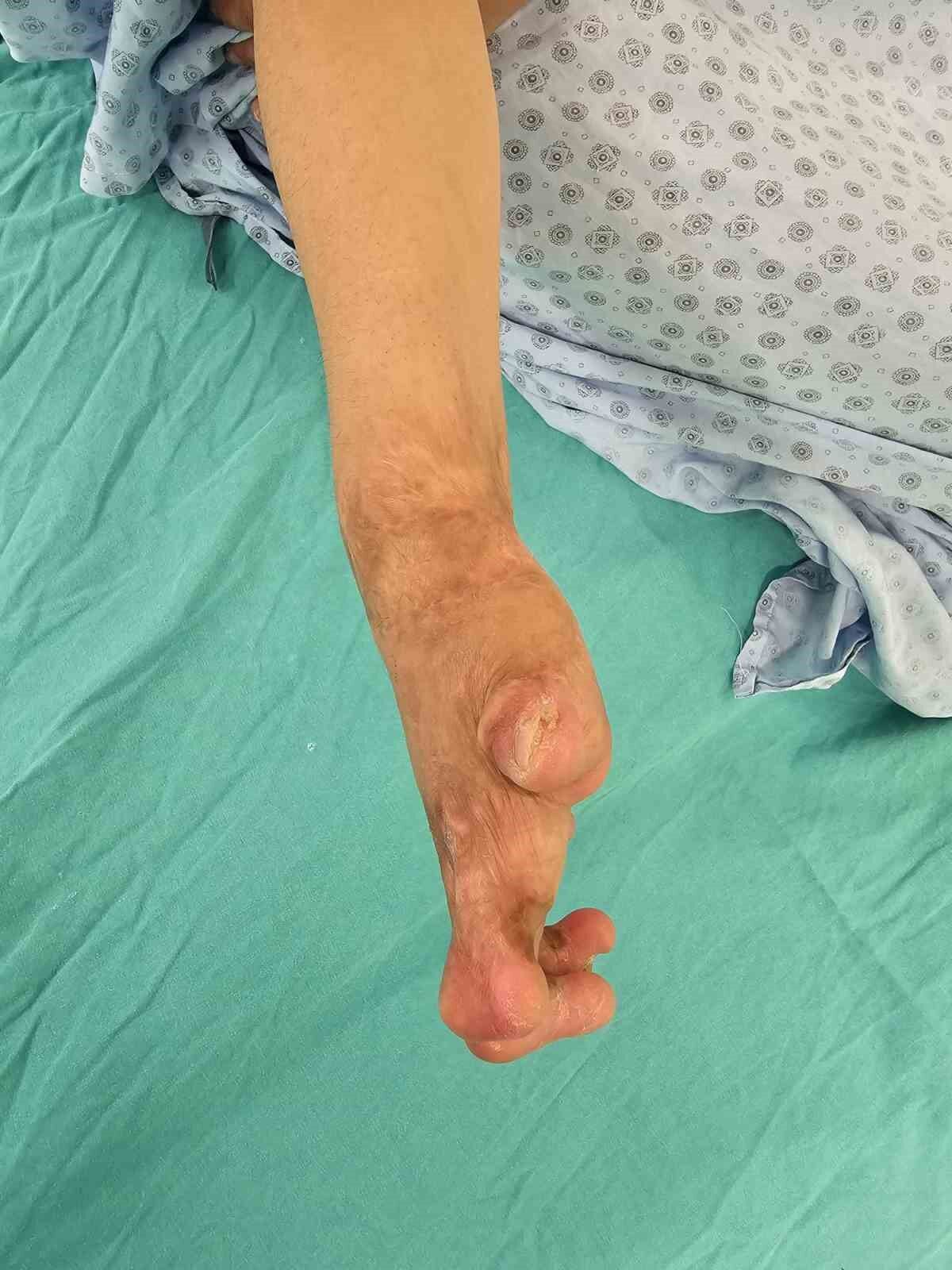 Çin zulmünden kaçan Uygur Türk’ü Ayşe, Eskişehir’de şifa buldu