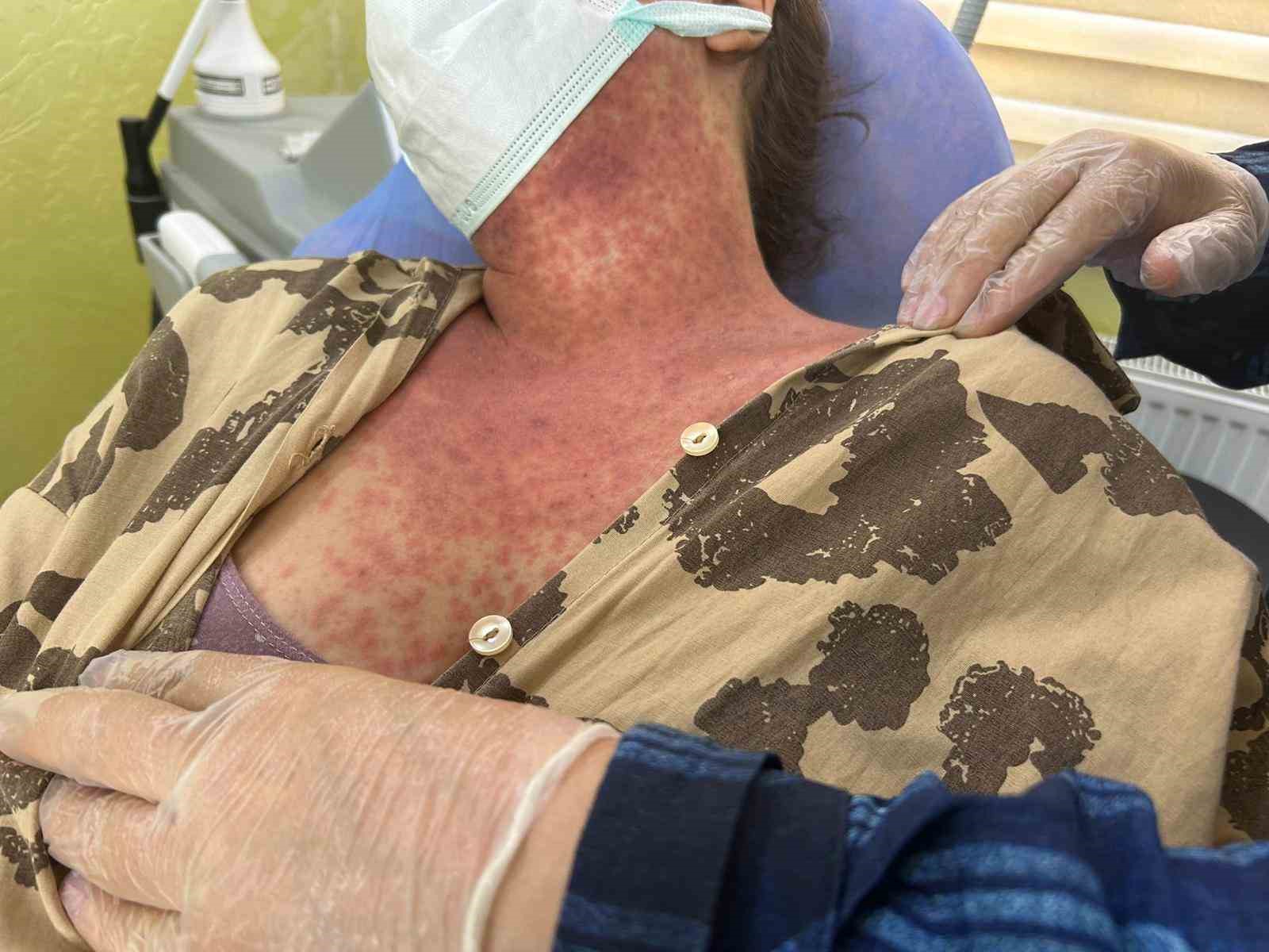 Van’da ‘beyazlatıcı krem’ faciası: 4 kişi hastanelik oldu