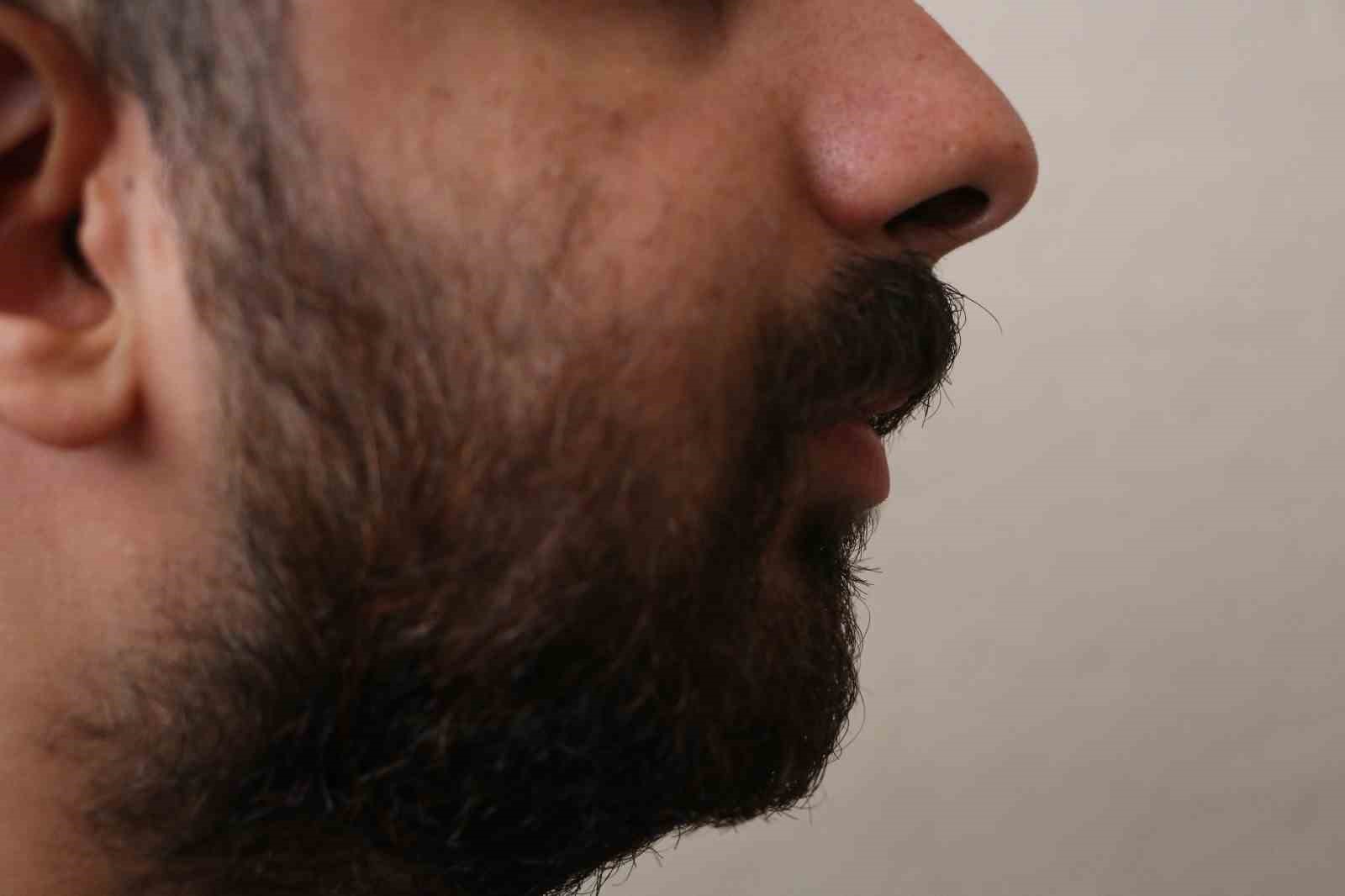 5 yaşındayken geçirdiği havale sonucu çene yapısı bozuldu, 21 yıldır sağlığına kavuşmanın hayaliyle yaşıyor