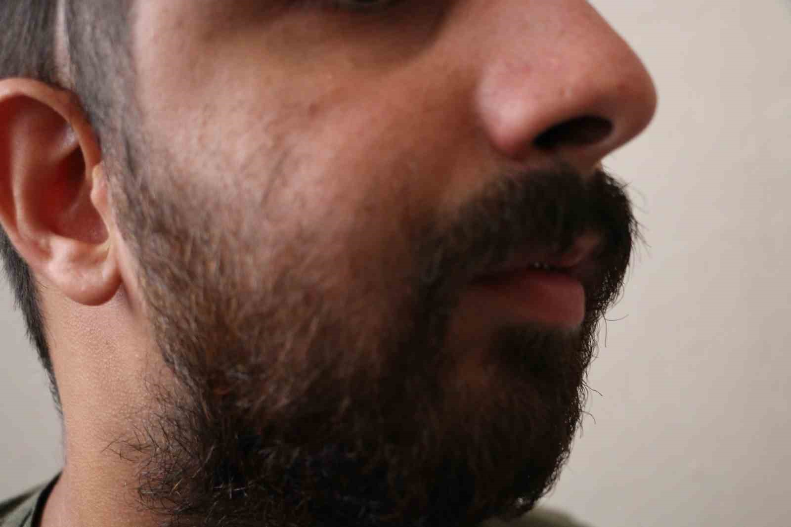 5 yaşındayken geçirdiği havale sonucu çene yapısı bozuldu, 21 yıldır sağlığına kavuşmanın hayaliyle yaşıyor