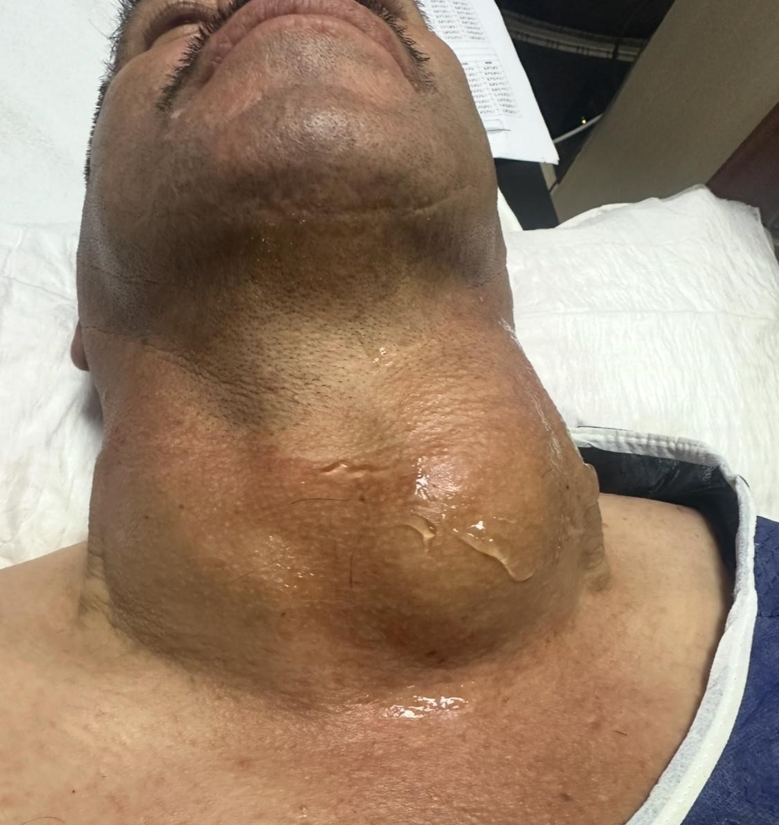 Kütahya’da dev guatr ameliyatsız tedavi edildi: Yüzde 90’dan fazla küçülme oldu