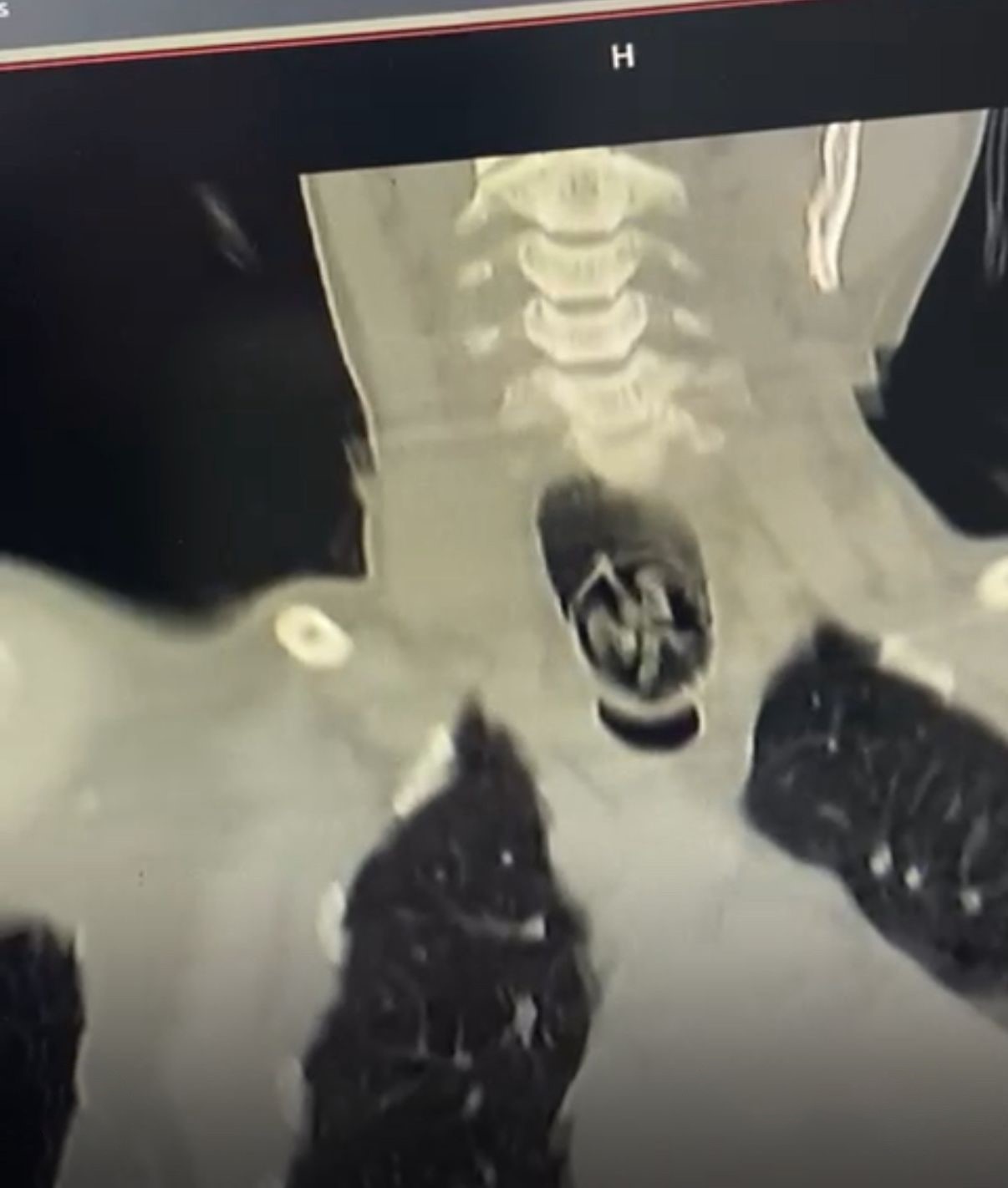 Ağrı’da yuttuğu ceviz yemek borusundan çıkarıldı