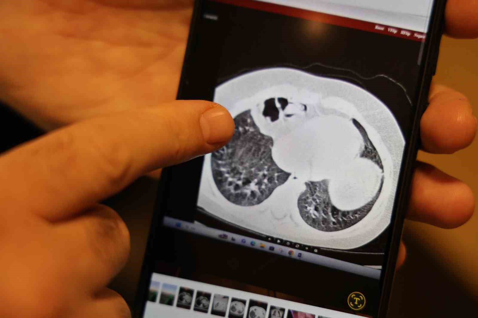 Doğuştan 200 binde bir görülen hastalıkla 2 yıl boyunca yaşayan çocuk sağlığına kavuştu