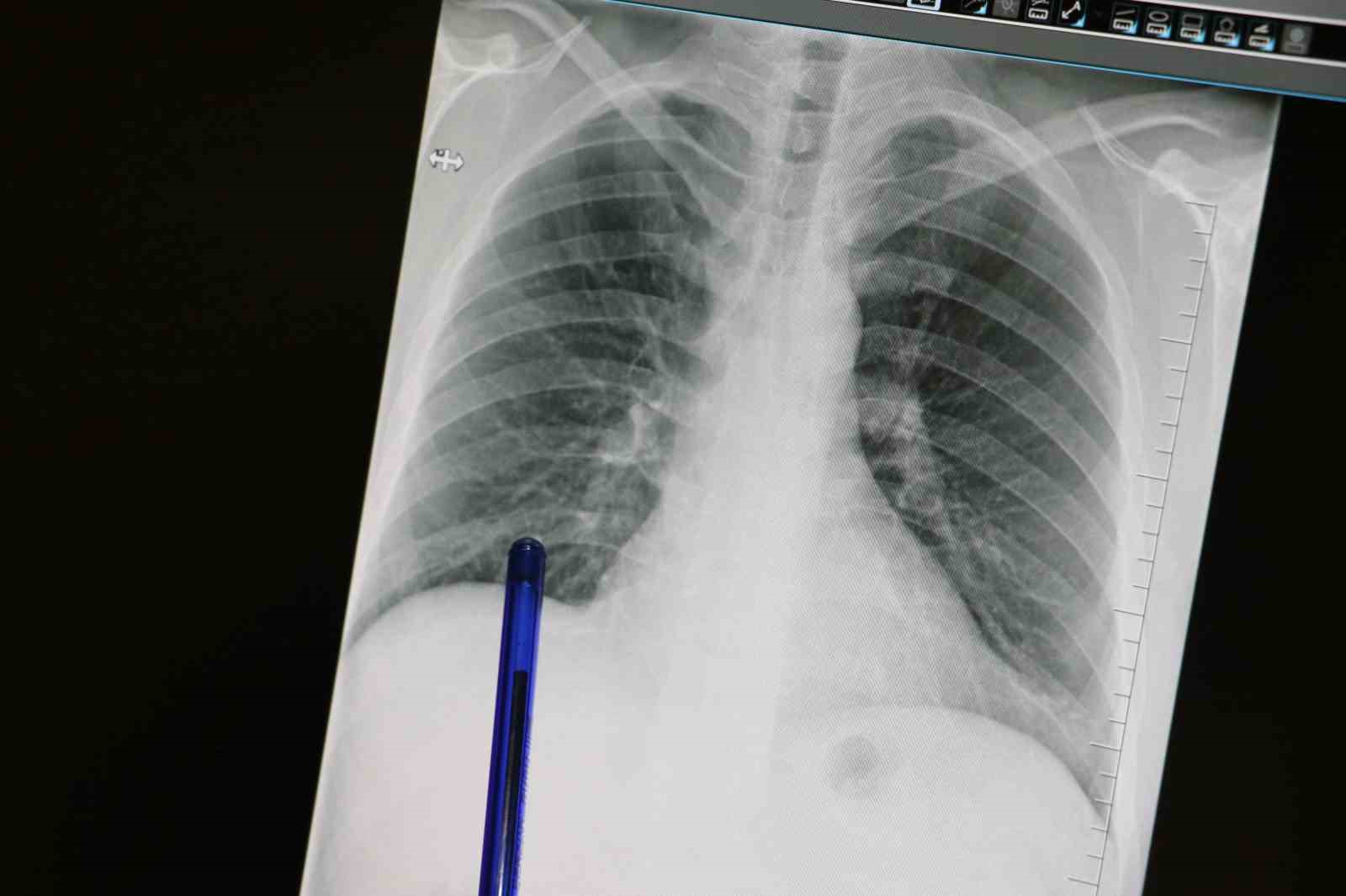 Basit gibi görünen semptomlar, kanserin habercisi olabilir